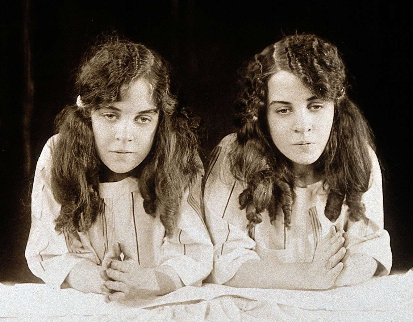 Siamesische Zwillinge Hilton